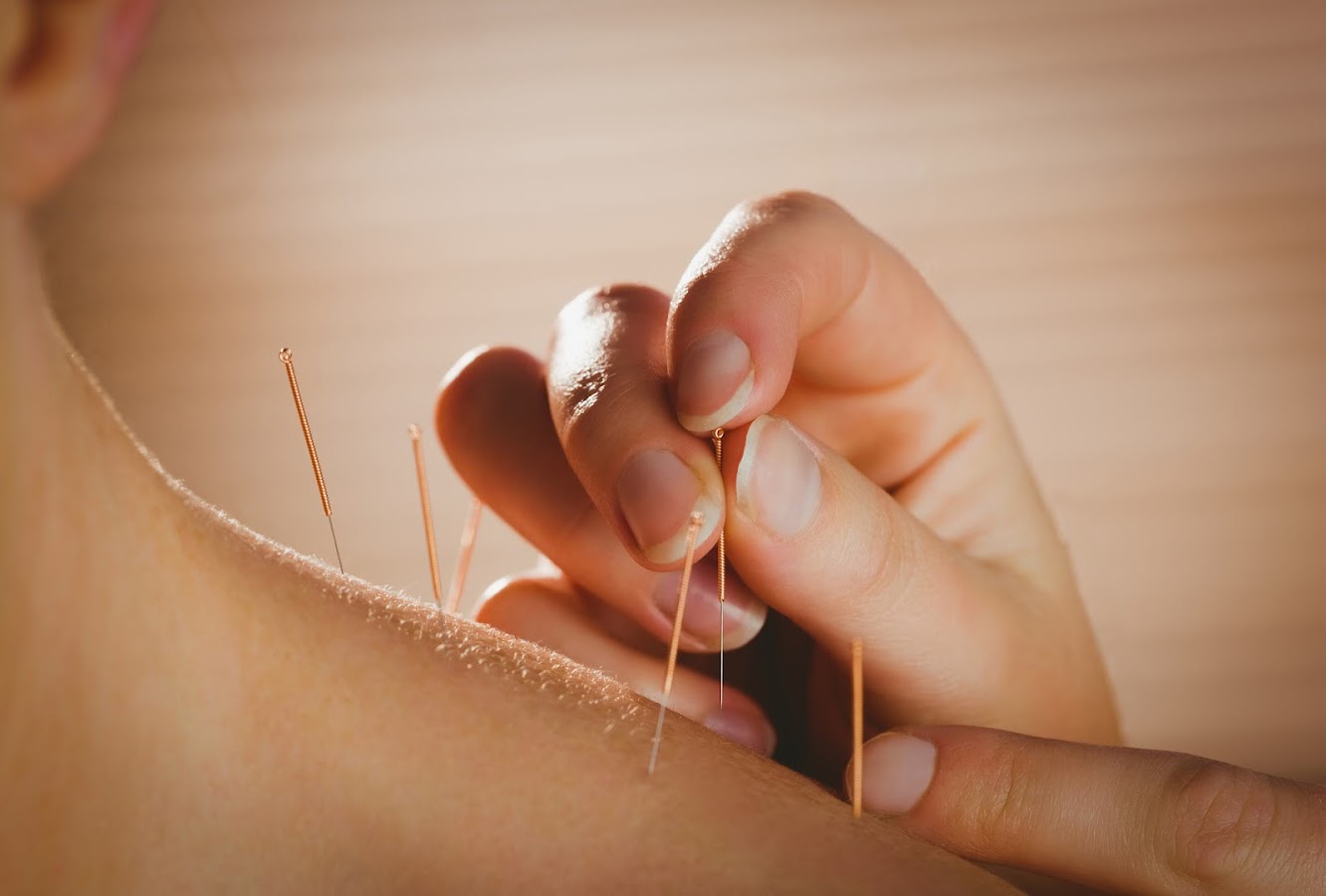 Acupuncture, Fire Cupping, Cranial Sacral Therapy and Kore by Innovative Treatments